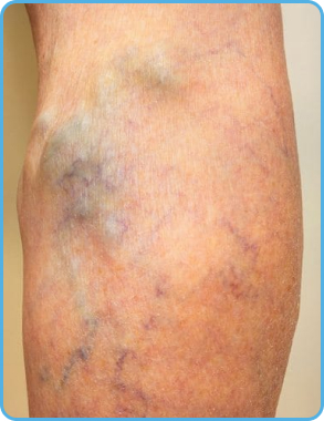 Laser Skin Brightening